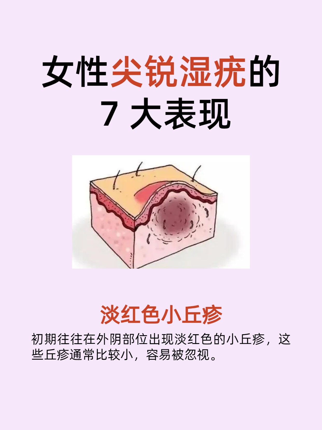 尖锐湿疣初期症状图片_(尖锐湿疣初期症状图片口腔)  第2张