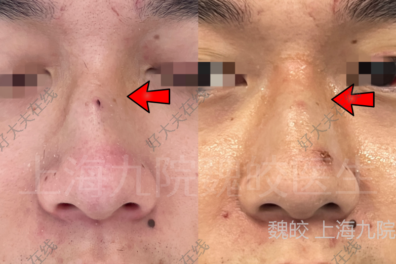 深圳新鹏城：廖力生已完成手术出院修复骨折鼻骨的简单介绍  第2张